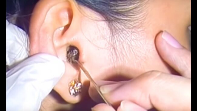 kekotoran terimpak di telinga kekotoran terimpak di telinga impacted earwax
